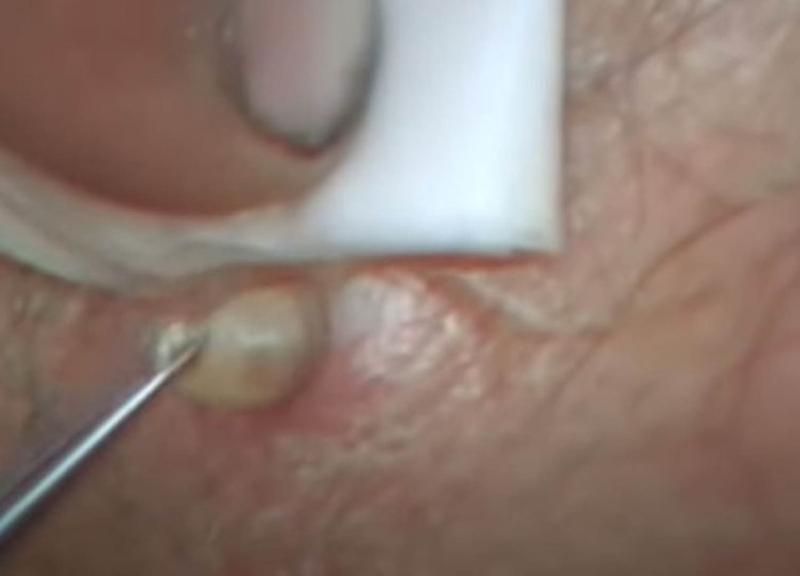 Sivilce zannetti ama gerçek dehşete düşürdü! 63