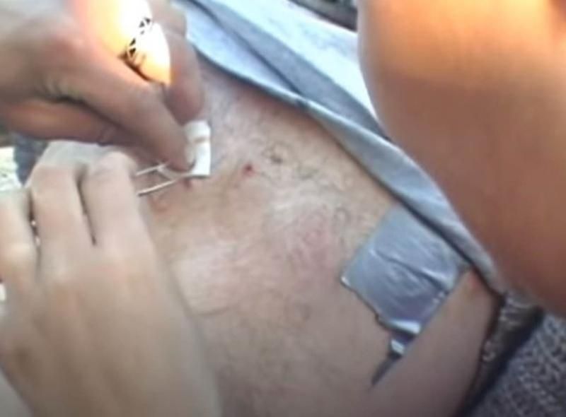 Sivilce zannetti ama gerçek dehşete düşürdü! 64