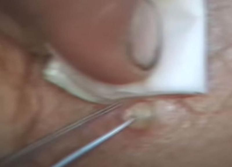 Sivilce zannetti ama gerçek dehşete düşürdü! 66