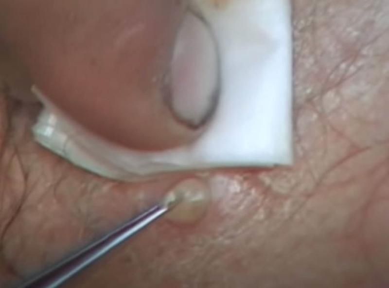 Sivilce zannetti ama gerçek dehşete düşürdü! 32