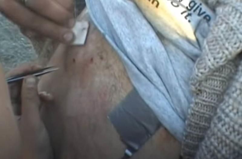 Sivilce zannetti ama gerçek dehşete düşürdü! 33