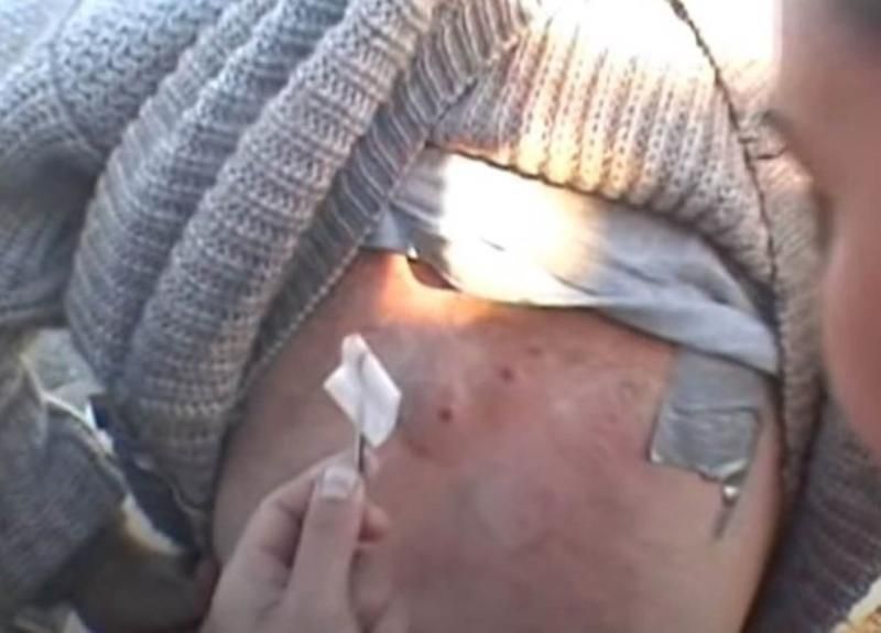 Sivilce zannetti ama gerçek dehşete düşürdü! 3