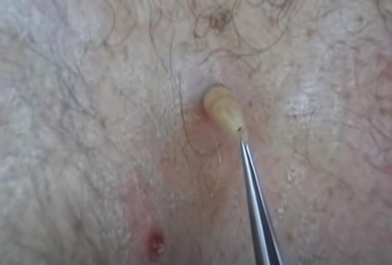 Sivilce zannetti ama gerçek dehşete düşürdü! 27