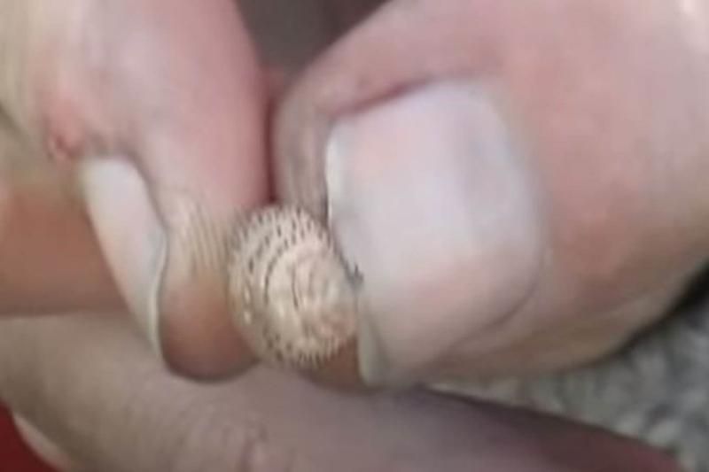 Sivilce zannetti ama gerçek dehşete düşürdü! 69