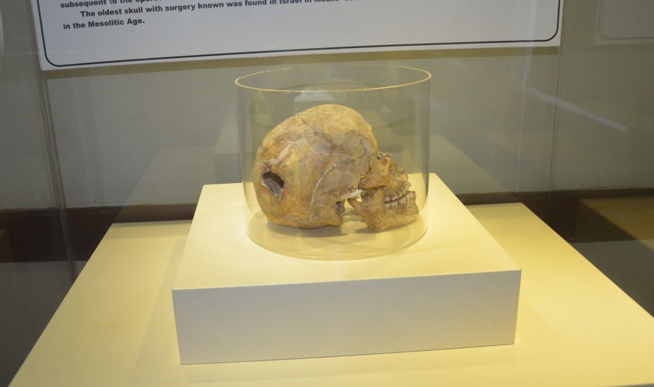 3 bin yıllık kafatasında ameliyat izi 1