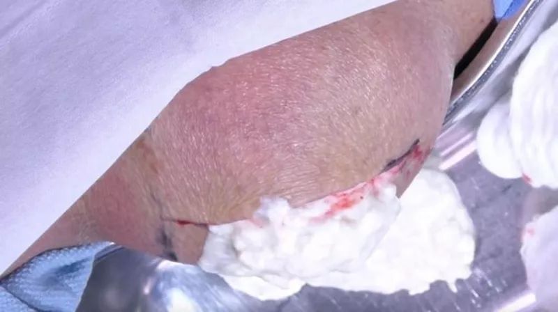 Bacağından çıkanlar doktoru bile şaşırttı! 48