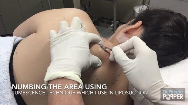 Sırtındaki şişliğin içinden çıkanlar görenleri şoke etti! 1