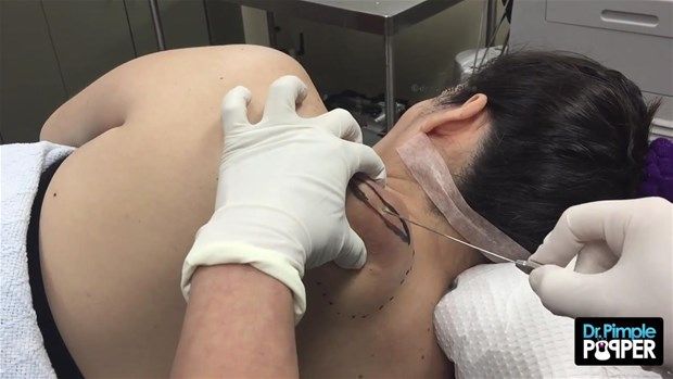 Sırtındaki şişliğin içinden çıkanlar görenleri şoke etti! 2