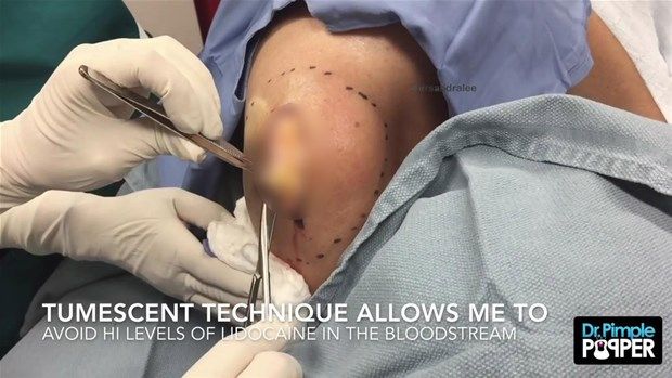 Sırtındaki şişliğin içinden çıkanlar görenleri şoke etti! 7