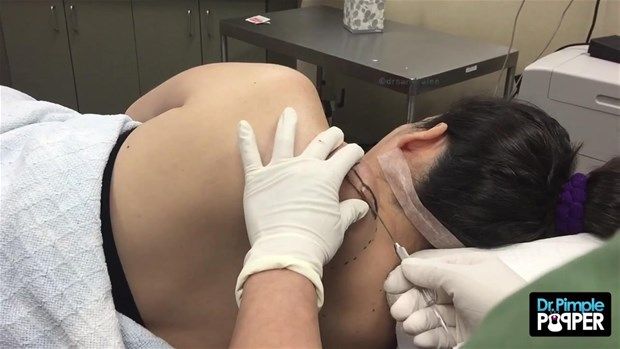 Sırtındaki şişliğin içinden çıkanlar görenleri şoke etti! 3