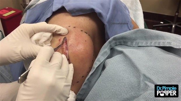 Sırtındaki şişliğin içinden çıkanlar görenleri şoke etti! 5