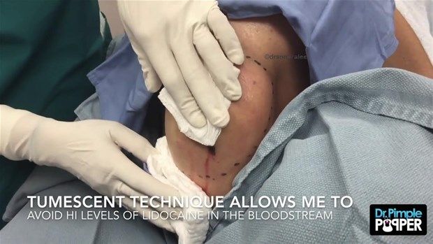 Sırtındaki şişliğin içinden çıkanlar görenleri şoke etti! 6