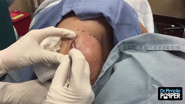 Sırtındaki şişliğin içinden çıkanlar görenleri şoke etti! 4