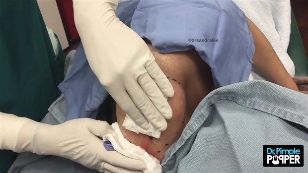 Sırtındaki şişliğin içinden çıkanlar görenleri şoke etti! 10