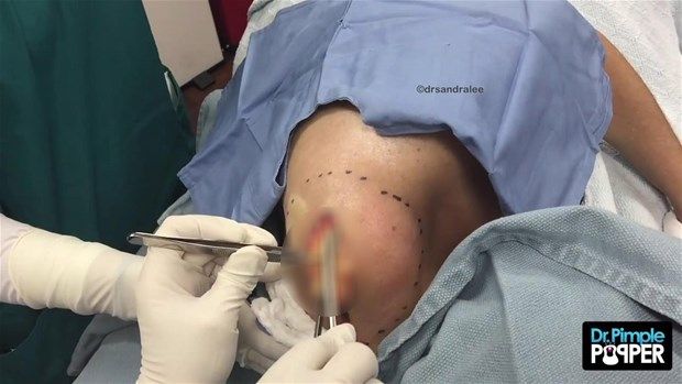 Sırtındaki şişliğin içinden çıkanlar görenleri şoke etti! 9