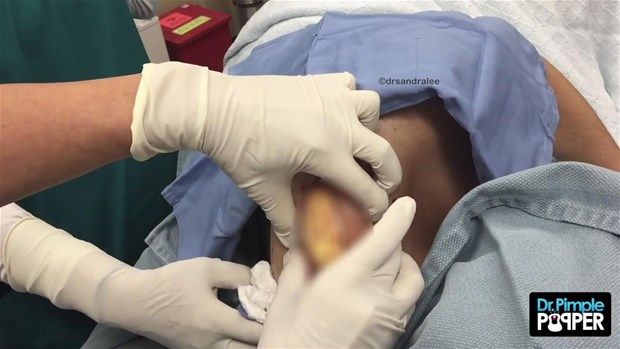 Sırtındaki şişliğin içinden çıkanlar görenleri şoke etti! 8