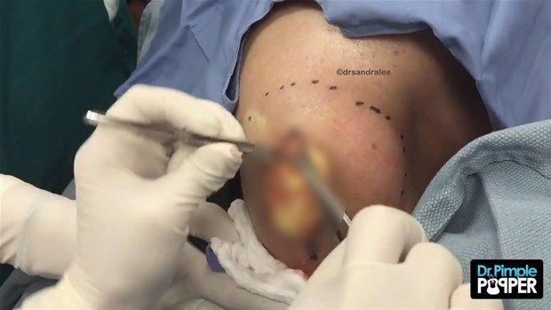 Sırtındaki şişliğin içinden çıkanlar görenleri şoke etti! 11