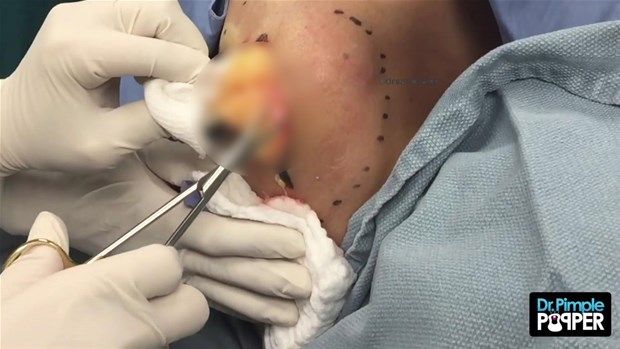 Sırtındaki şişliğin içinden çıkanlar görenleri şoke etti! 12