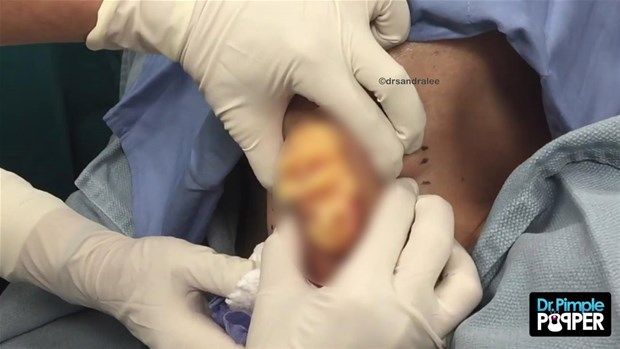 Sırtındaki şişliğin içinden çıkanlar görenleri şoke etti! 13