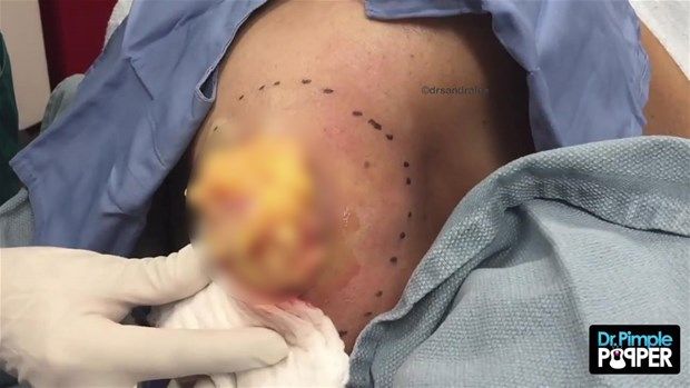 Sırtındaki şişliğin içinden çıkanlar görenleri şoke etti! 15