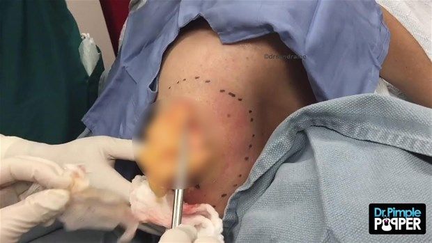 Sırtındaki şişliğin içinden çıkanlar görenleri şoke etti! 17