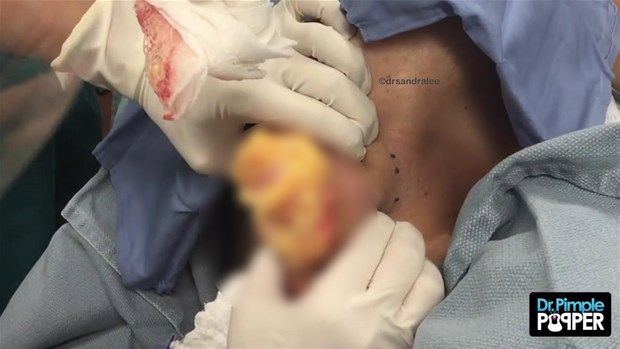 Sırtındaki şişliğin içinden çıkanlar görenleri şoke etti! 14