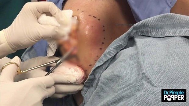 Sırtındaki şişliğin içinden çıkanlar görenleri şoke etti! 20