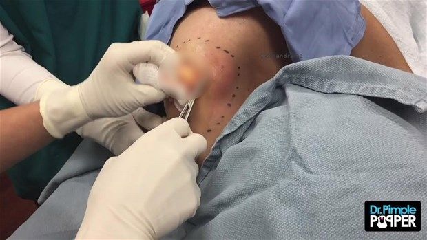 Sırtındaki şişliğin içinden çıkanlar görenleri şoke etti! 19