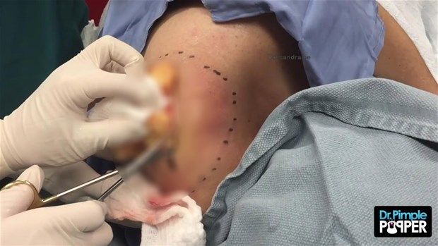 Sırtındaki şişliğin içinden çıkanlar görenleri şoke etti! 18