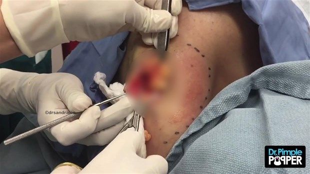 Sırtındaki şişliğin içinden çıkanlar görenleri şoke etti! 25