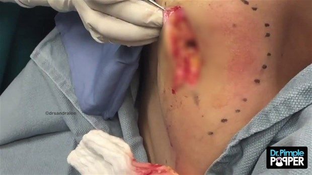 Sırtındaki şişliğin içinden çıkanlar görenleri şoke etti! 27