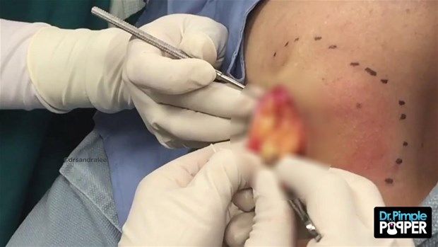 Sırtındaki şişliğin içinden çıkanlar görenleri şoke etti! 26