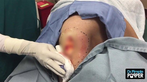 Sırtındaki şişliğin içinden çıkanlar görenleri şoke etti! 23