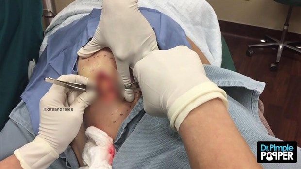 Sırtındaki şişliğin içinden çıkanlar görenleri şoke etti! 28