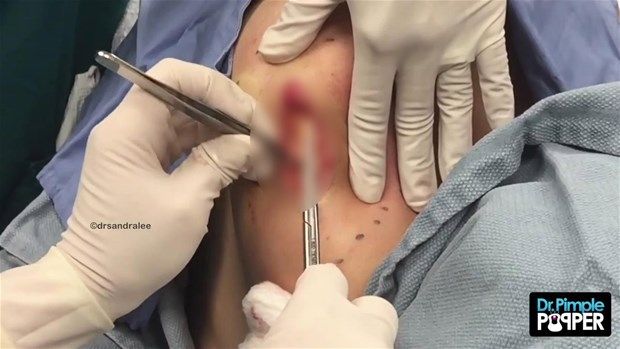 Sırtındaki şişliğin içinden çıkanlar görenleri şoke etti! 29