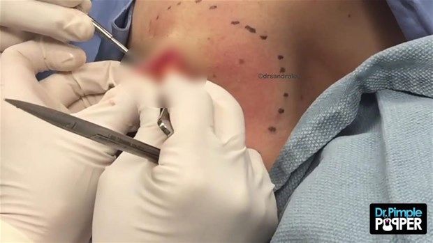 Sırtındaki şişliğin içinden çıkanlar görenleri şoke etti! 30