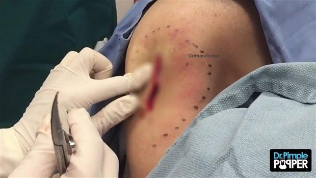 Sırtındaki şişliğin içinden çıkanlar görenleri şoke etti! 32