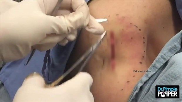 Sırtındaki şişliğin içinden çıkanlar görenleri şoke etti! 36