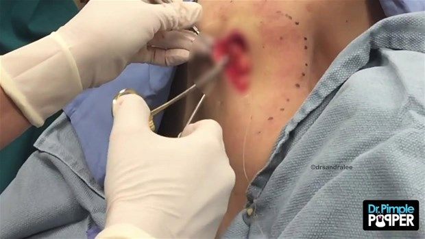 Sırtındaki şişliğin içinden çıkanlar görenleri şoke etti! 35