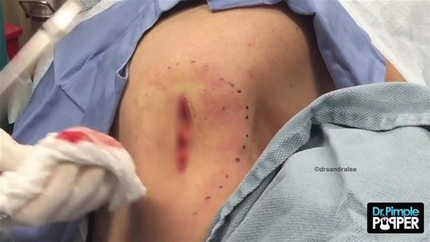 Sırtındaki şişliğin içinden çıkanlar görenleri şoke etti! 34