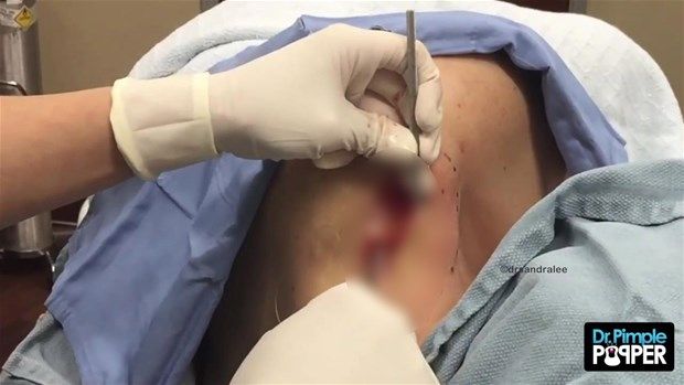 Sırtındaki şişliğin içinden çıkanlar görenleri şoke etti! 33