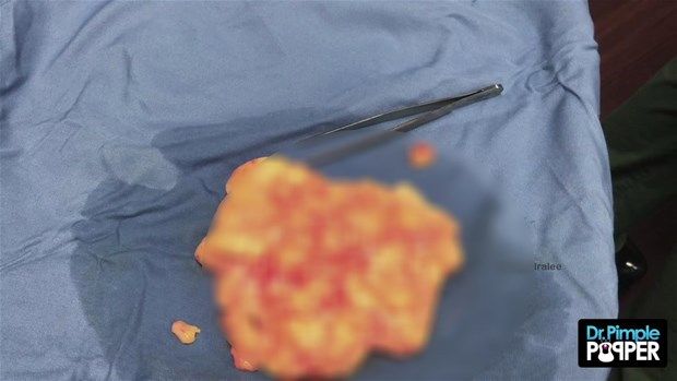 Sırtındaki şişliğin içinden çıkanlar görenleri şoke etti! 41