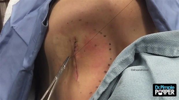 Sırtındaki şişliğin içinden çıkanlar görenleri şoke etti! 40