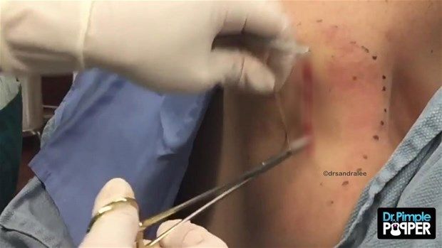 Sırtındaki şişliğin içinden çıkanlar görenleri şoke etti! 38