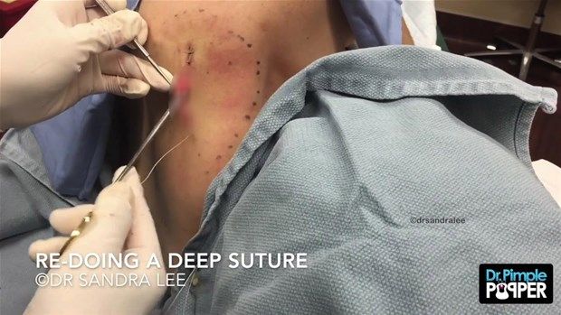 Sırtındaki şişliğin içinden çıkanlar görenleri şoke etti! 39