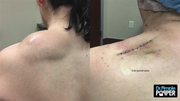 Sırtındaki şişliğin içinden çıkanlar görenleri şoke etti! 42