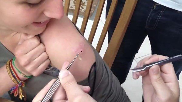 Sivilce zannetti doktora gitti! İçinden çıkanlar şoke etti 26