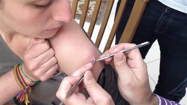 Sivilce zannetti doktora gitti! İçinden çıkanlar şoke etti 20