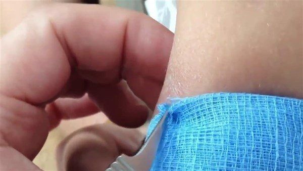 Sivilce zannetti doktora gitti! İçinden çıkanlar şoke etti 6