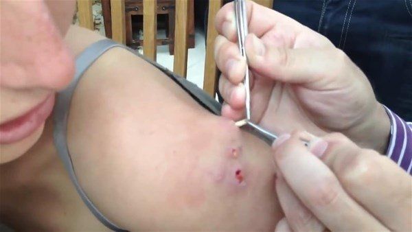 Sivilce zannetti doktora gitti! İçinden çıkanlar şoke etti 24